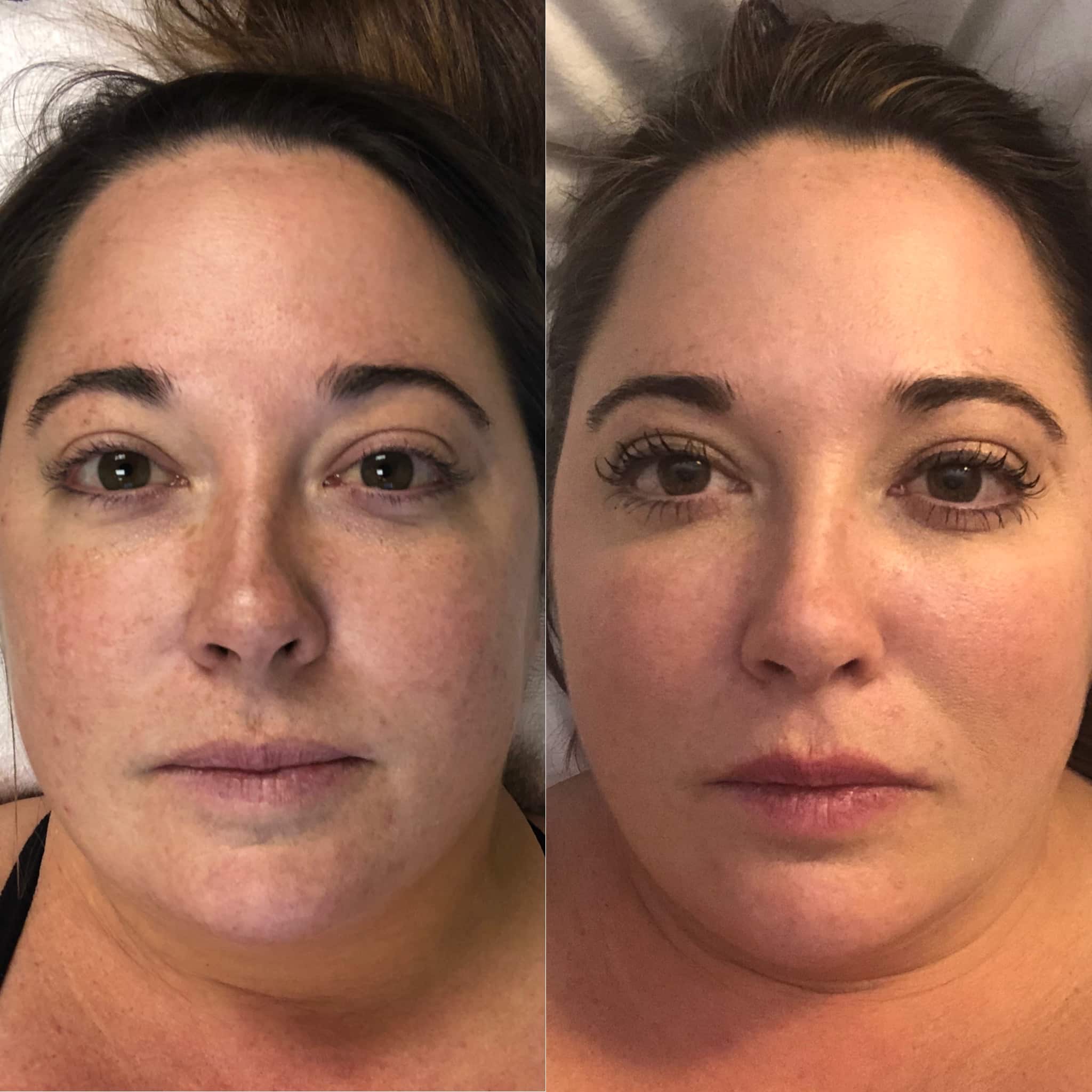 bbl photofacial before and after