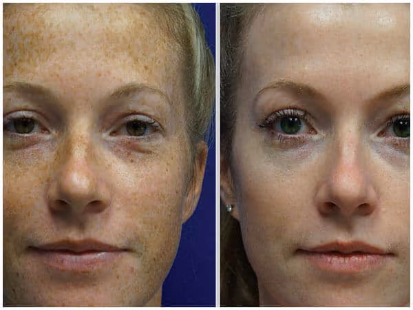 bbl photofacial before and after