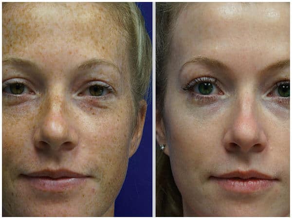bbl photofacial before and after