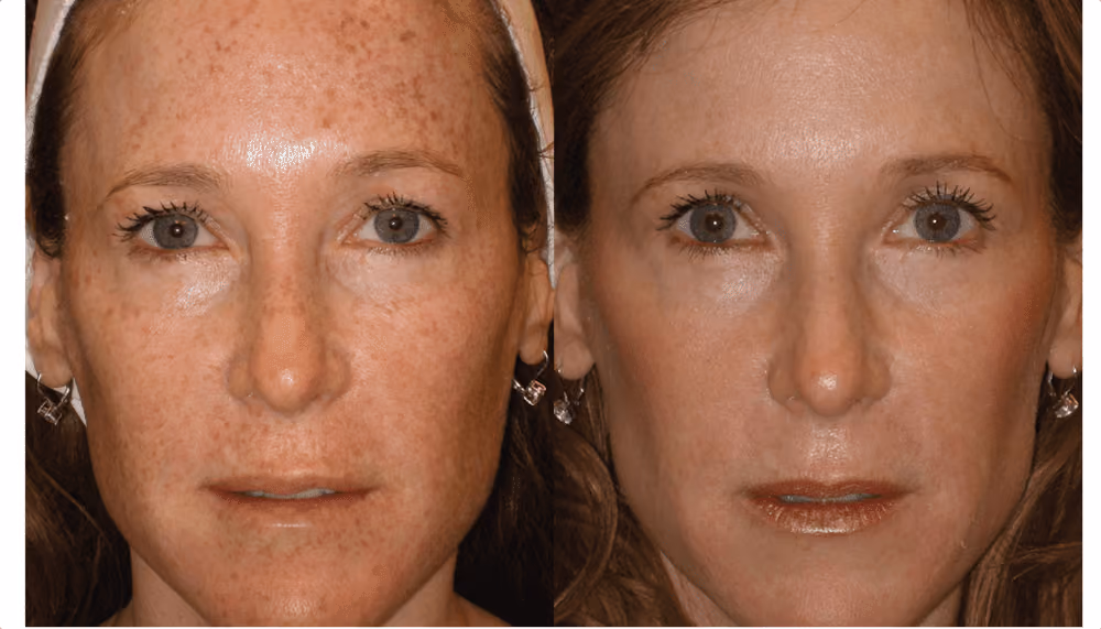 bbl photofacial before and after