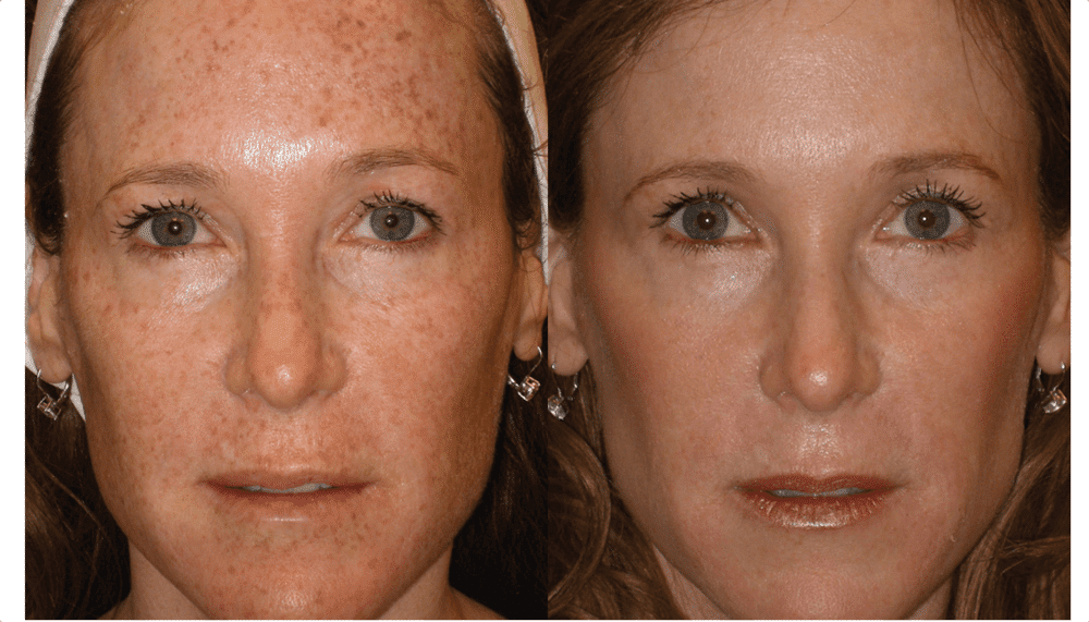 bbl photofacial before and after