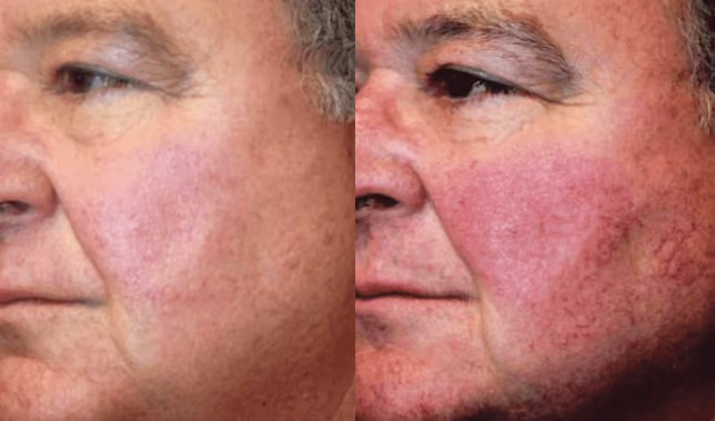 bbl photofacial before and after