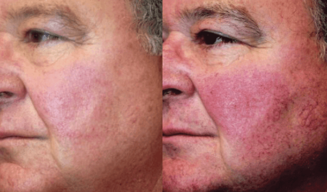 bbl photofacial before and after