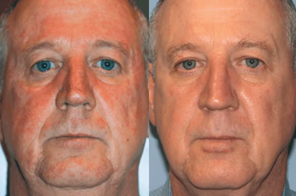 bbl photofacial before and after