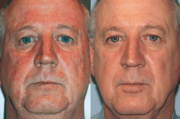 bbl photofacial before and after