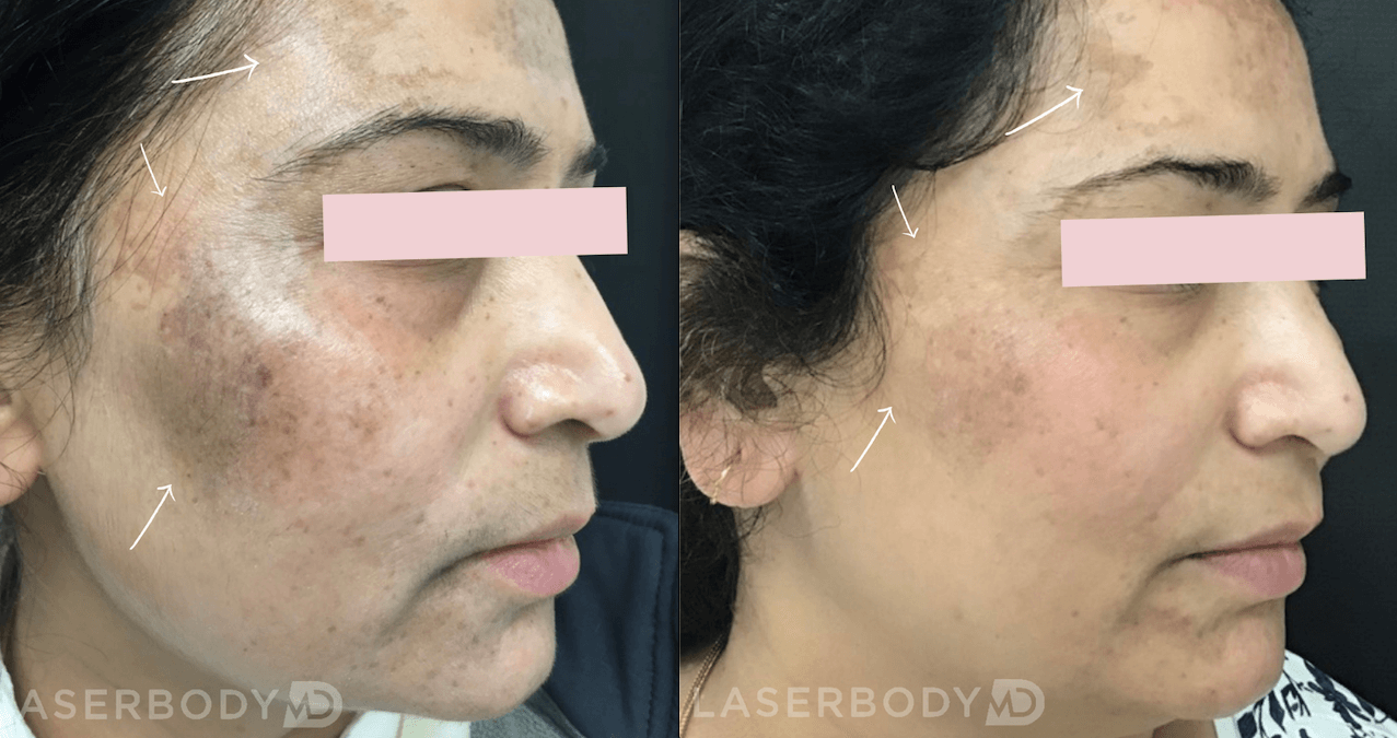 bbl photofacial before and after