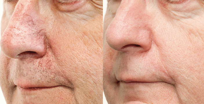 bbl photofacial before and after