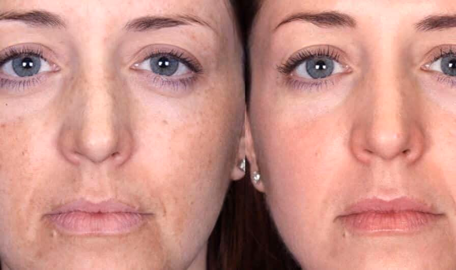 bbl photofacial before and after