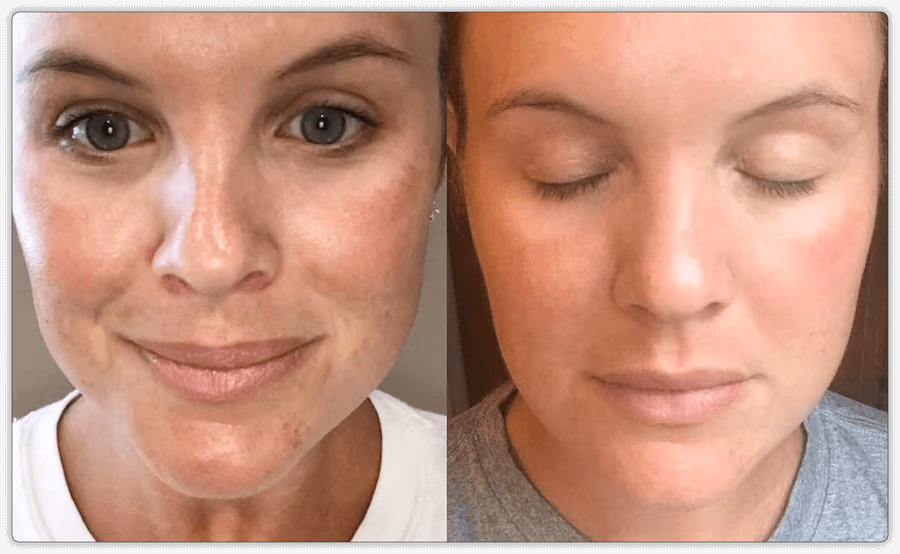 prp facial before and after