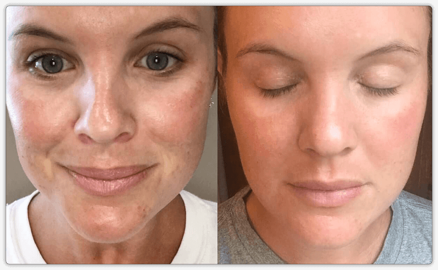 prp facial before and after