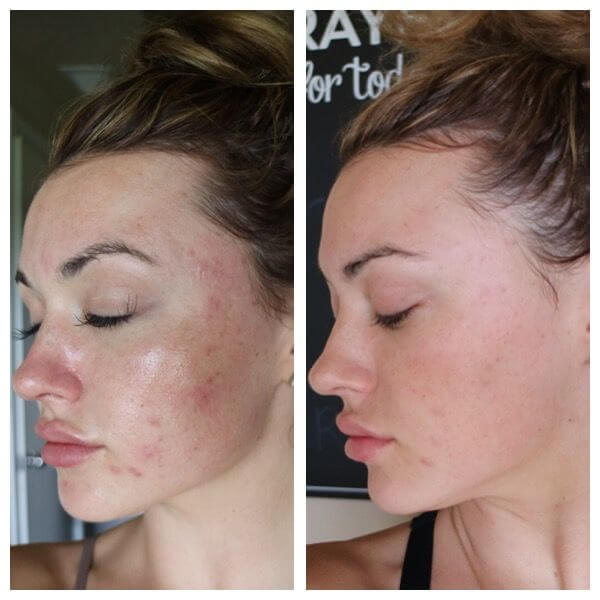 prp facial before and after