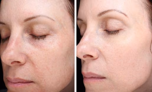 prp facial before and after