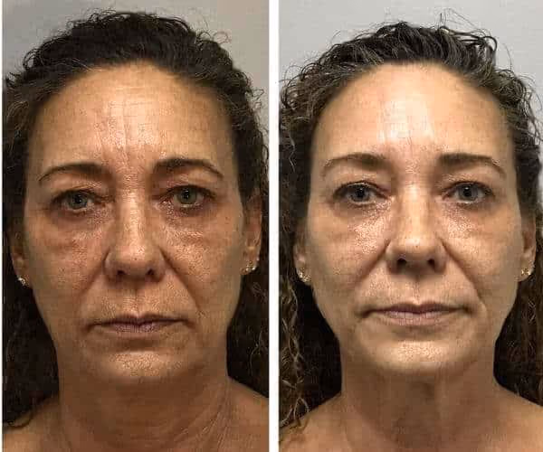 prp facial before and after