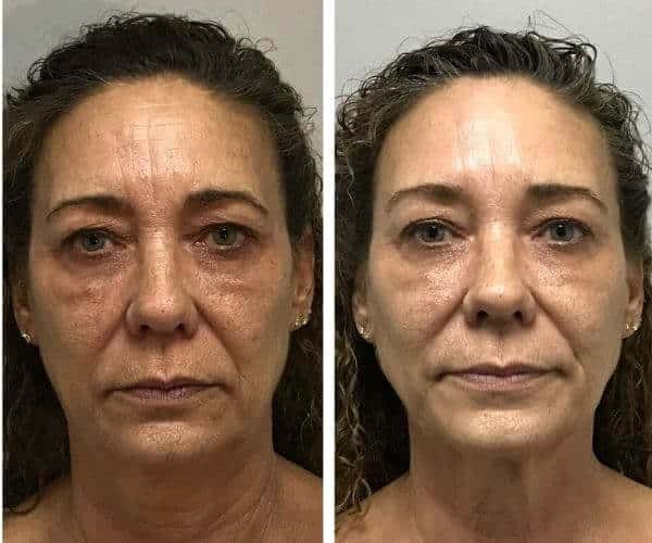 prp facial  before and after