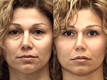 prp facial before and after