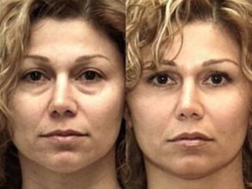 prp facial  before and after