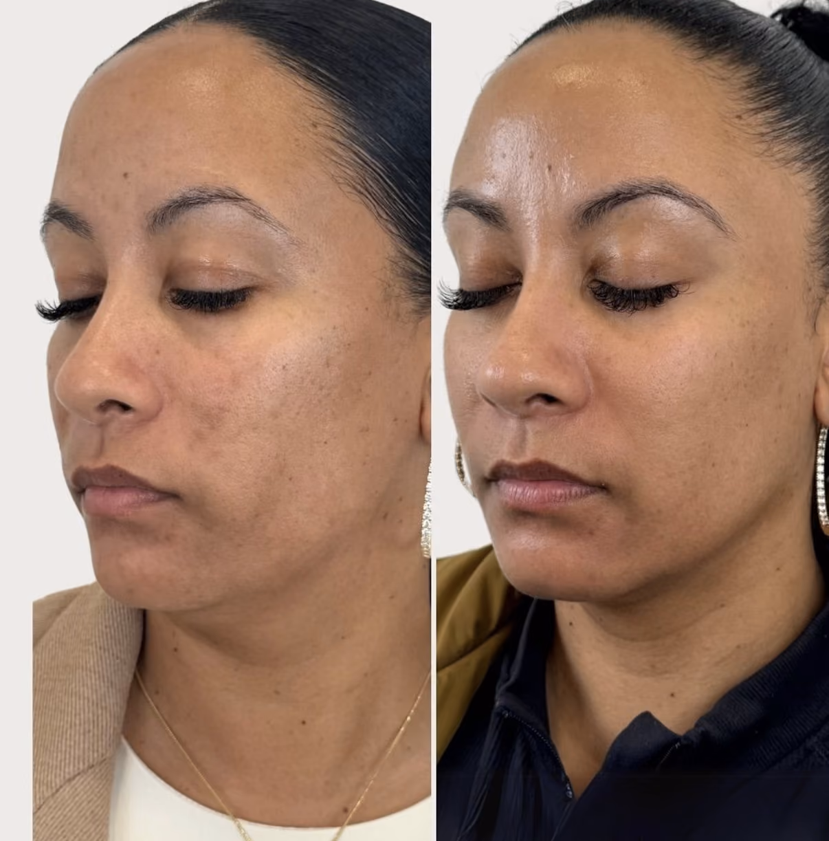 prp facial before and after