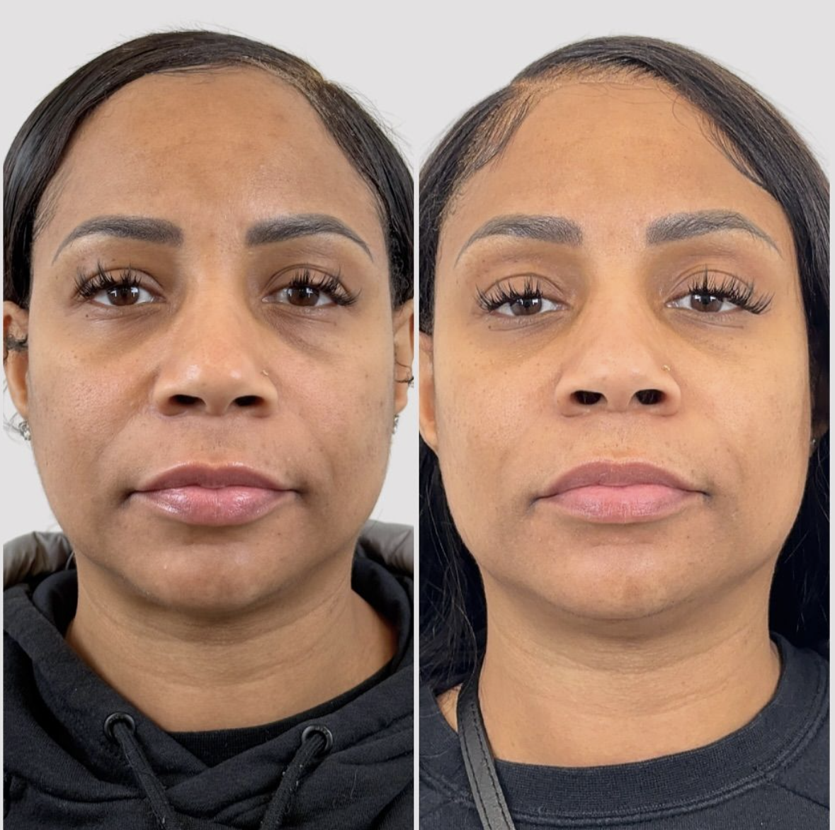 prp facial before and after