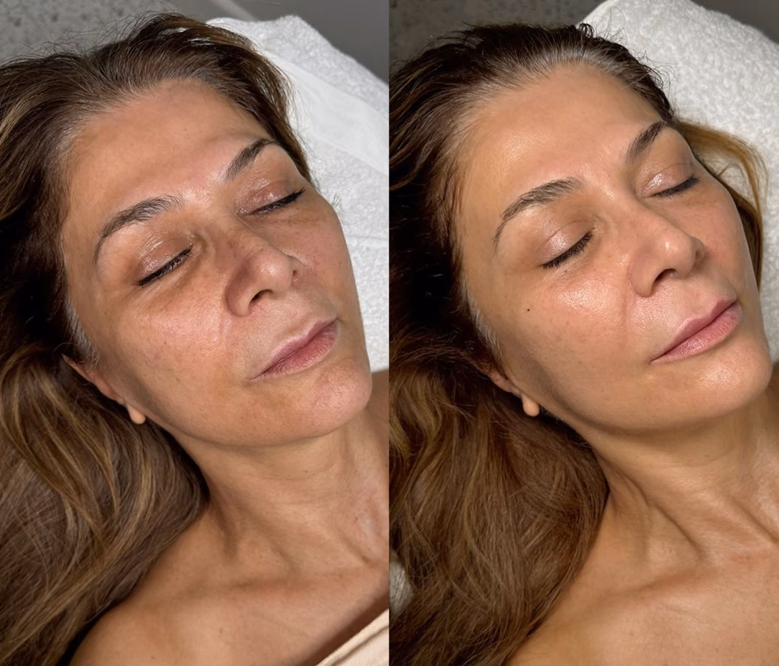 prp facial before and after