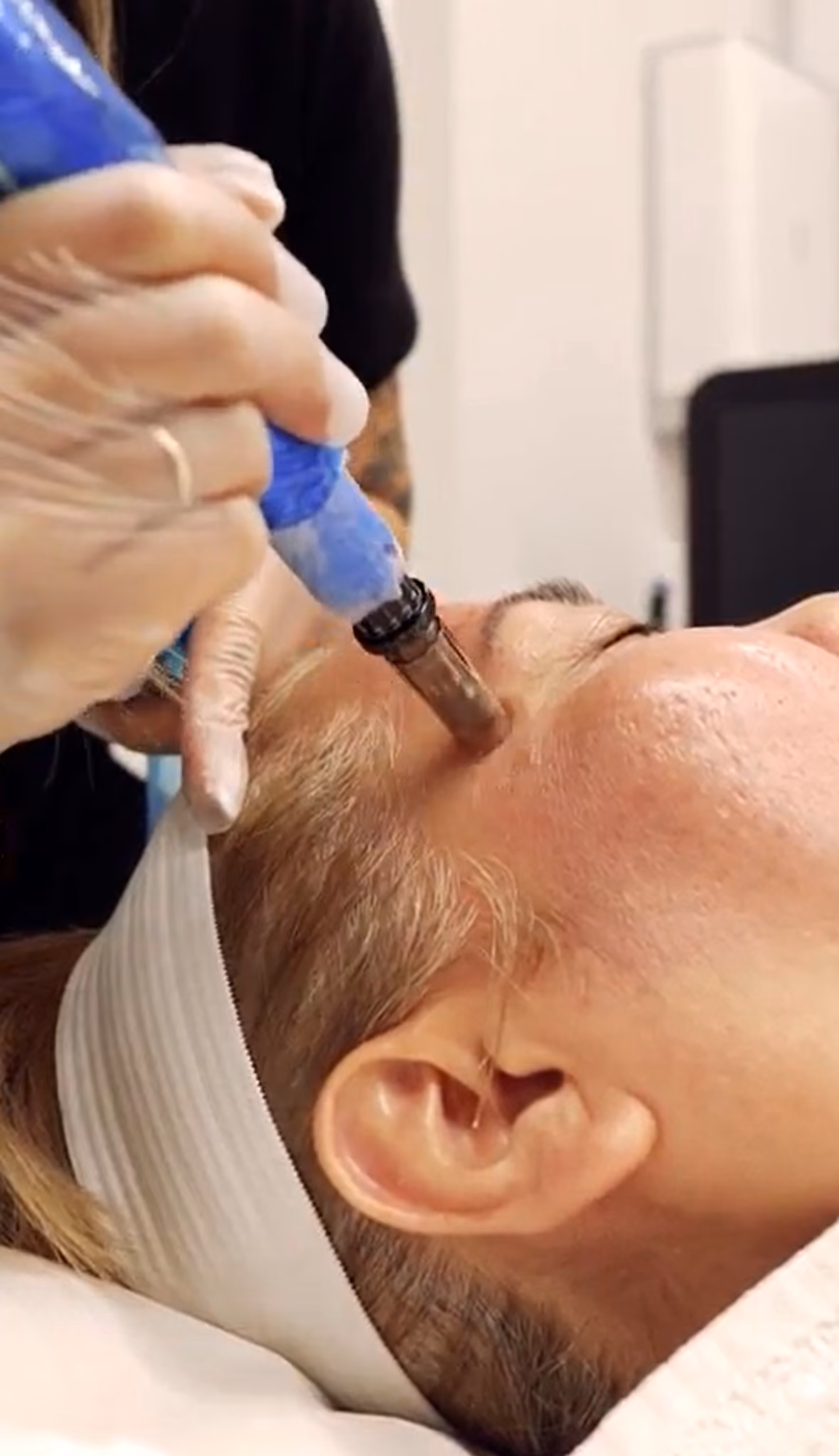 prp vampire facial treatment in toronto