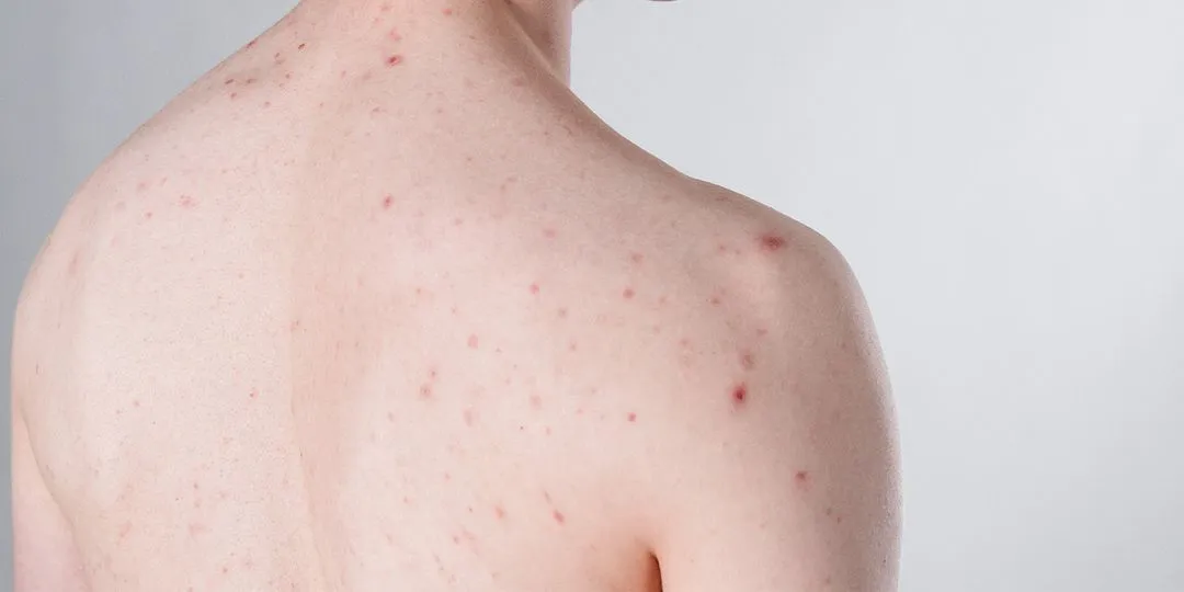 Bilde av gutt med alvorlig akne på ryggen.