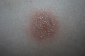 Närbild av nummulärt eksem: runt, rött och flagande utslag.