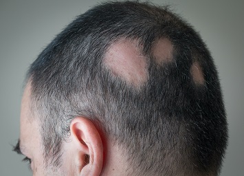 Mann med alopecia areata: Tre områder med flekkvis hårtap i bakhodet.