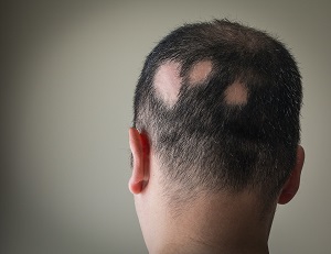 Mann med alopecia areata: Tre områder med flekkvis hårtap i bakhodet (zoomet ut).