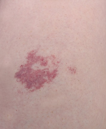 Närbild på portvinsfläck: röd pigmenterad födelsemärke.