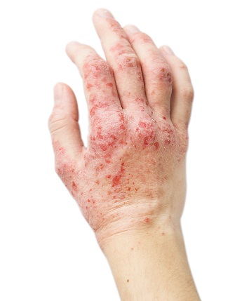 Eksem på handflatan: röd, torr och flagande utslag.