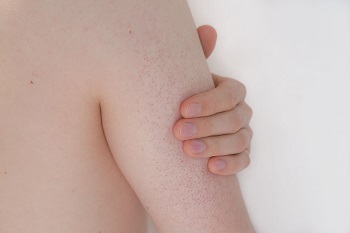 Person med keratosis pilaris på överarmen: små röda prickar i huden.