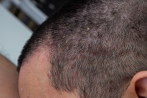 Man med mörkt, kort hår och fjällning i hårbotten.