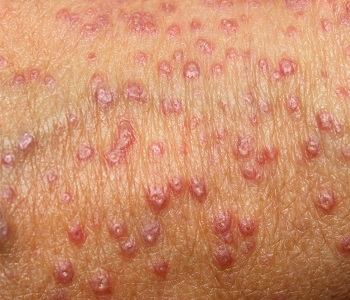 Närbild av lichen planus - röda prickar på huden.