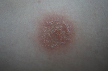 Närbild av nummulärt eksem: runt, röd och flagande utslag.