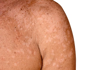 Person med Pityriasis versicolor – vita pigmentfläckar på axel och överarm.