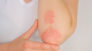 Albue med psoriasis: röda och flagnande utslag.