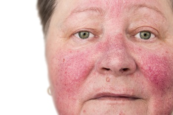 Kvinna med allvarlig Rosacea: röd utslag på kinderna och näsan.