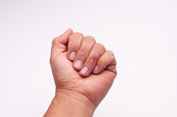 Hand med sklerodermi på ringfinger: Lila och rund hudförändring.