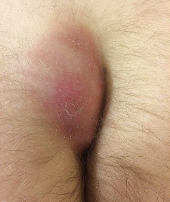 ©By Jonathanlund - Own work, CC BY-SA 4.0, https://commons.wikimedia.org/w/index.php?curid=53285675