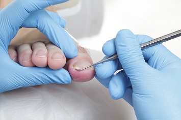 Fotterapeut lyfter försiktigt upp kanten av stortånageln.