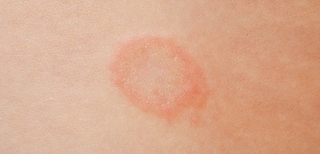 Nærbilde av ringorm på huden: Flassende, rødt, ringformet utslett.