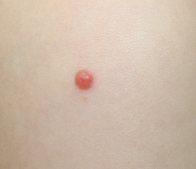 Spitz nevus födelsemärke - rosa och lätt upphöjt födelsemärke på huden.