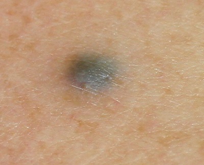 Blue nevus födelsemärke - blått födelsemärke på huden.