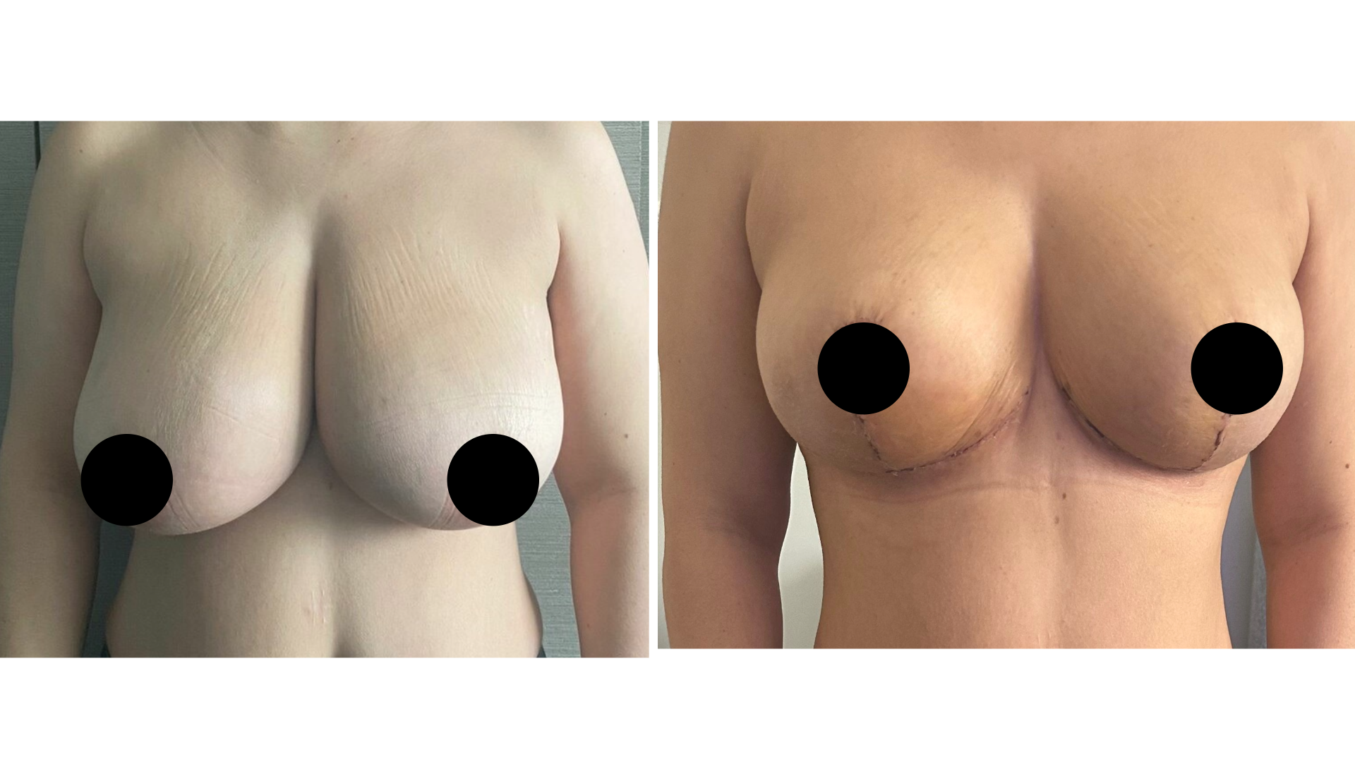 Breast reduction before and after, 3 weeks after surgery