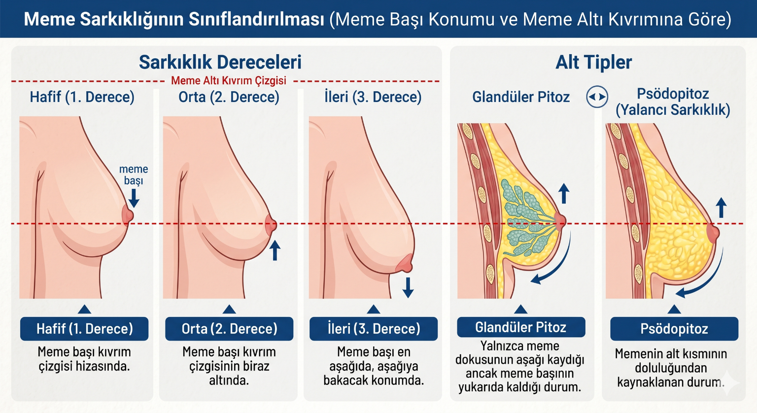 Meme sarkıklığının sınıflandırılması: meme başının meme altı kıvrım çizgisine göre konumuna bağlı hafif (1. derece), orta (2. derece) ve ileri (3. derece) sarkıklık ile glandüler pitoz ve psödopitoz (yalancı sarkıklık) alt tiplerinin şematik gösterimi.