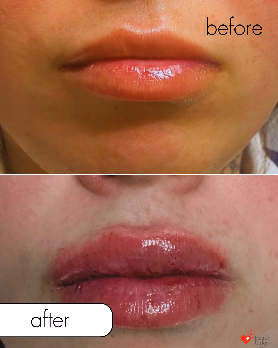 Lip filler before and after Istanbul, 1cc upper lip
