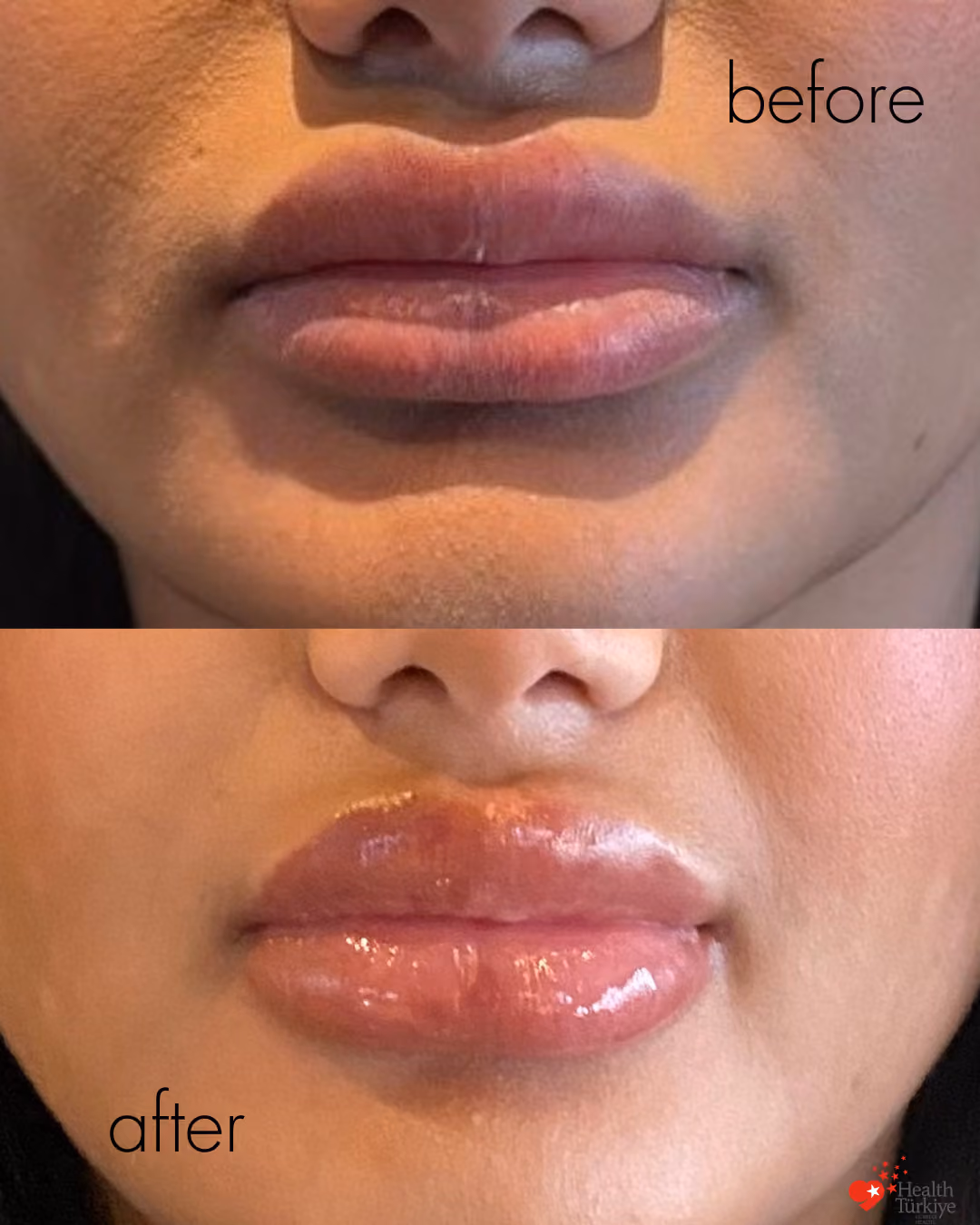 Lip filler before and after Istanbul, additional filler 3 day follow-up