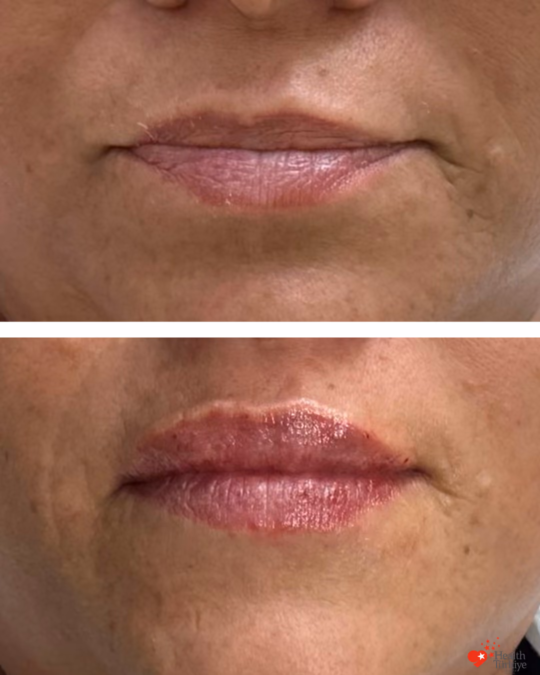 Lip filler before and after Istanbul, 1cc upper and lower lip