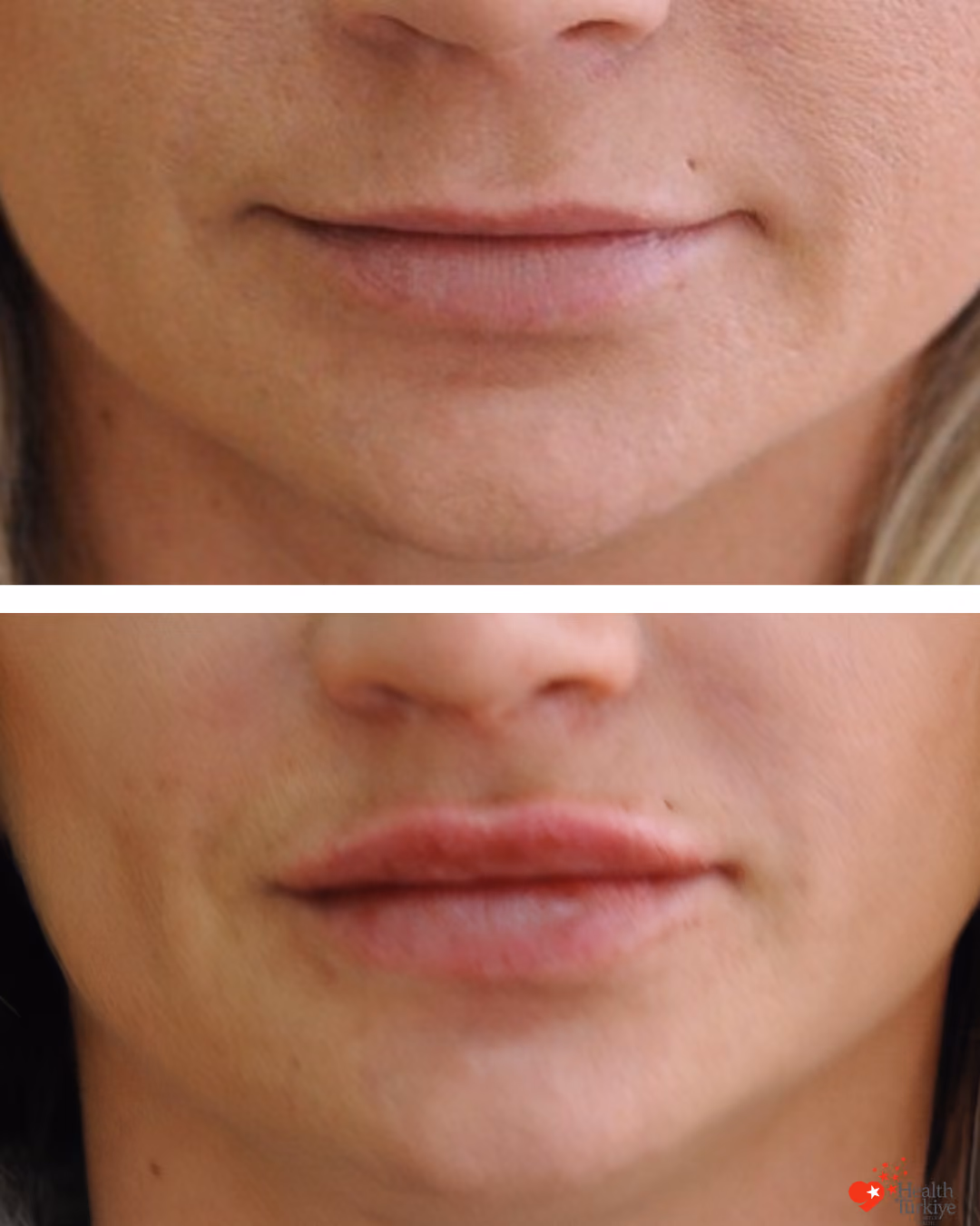 Lip filler before and after Istanbul, 0.7cc