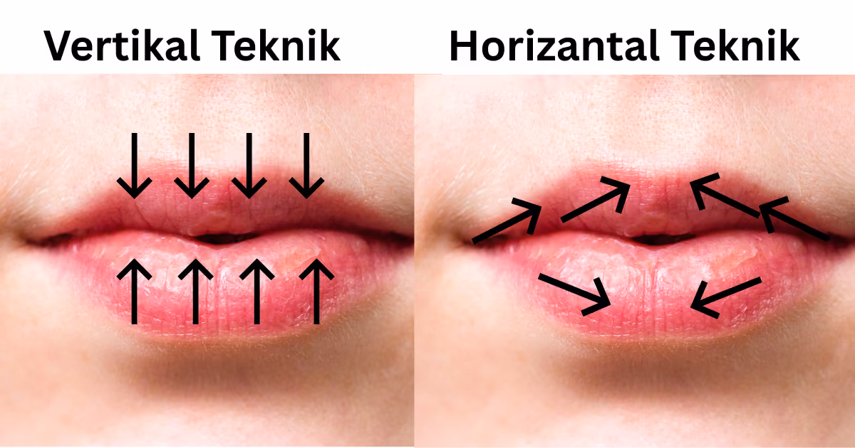 Russian (vertical) vs French (horizontal) lip filler injection technique comparison
